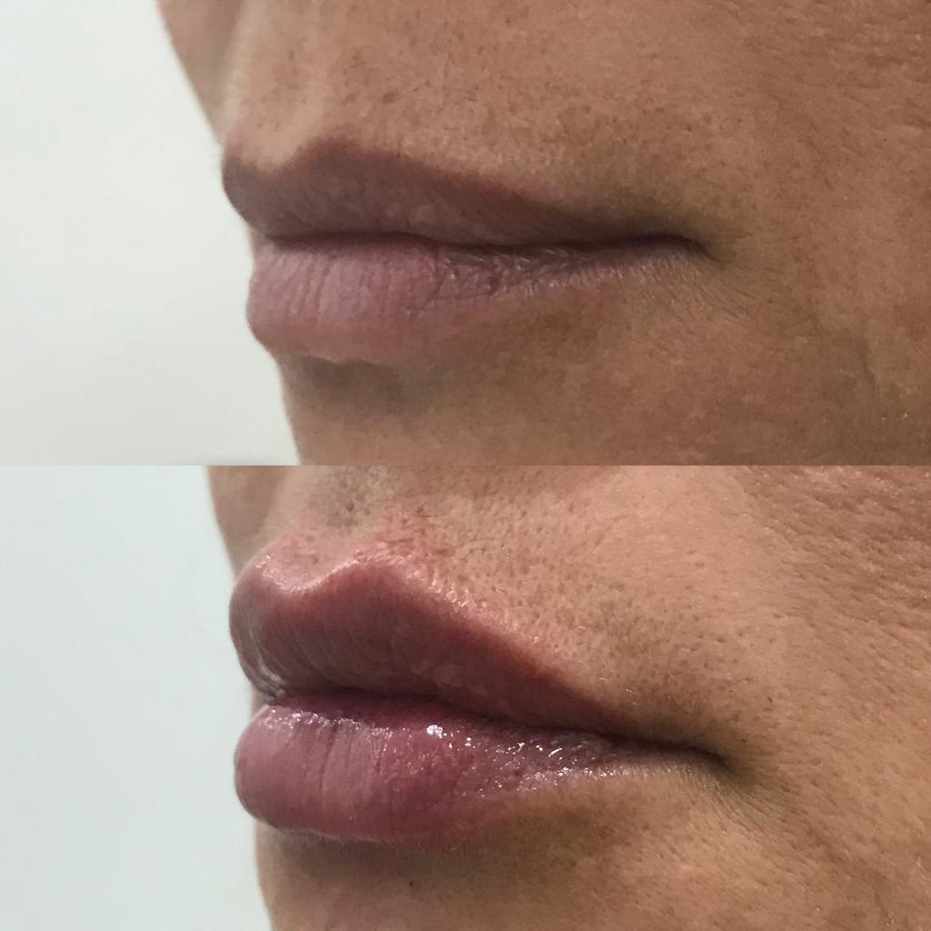 Antes e depois - harmonização labial