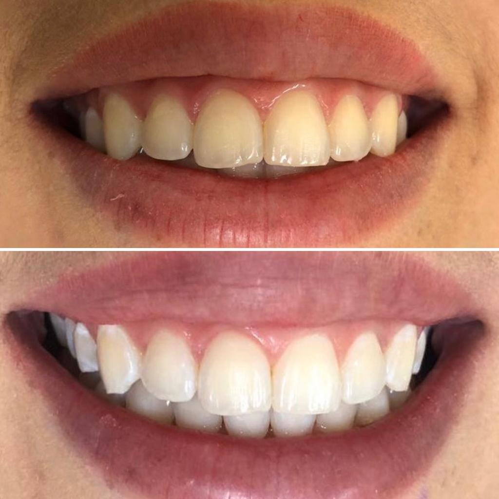 Antes e depois - clareamento e sorriso